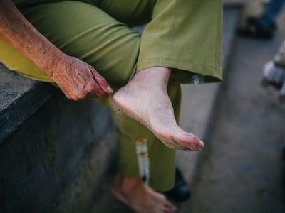 Close up of a person hands resting on knees.